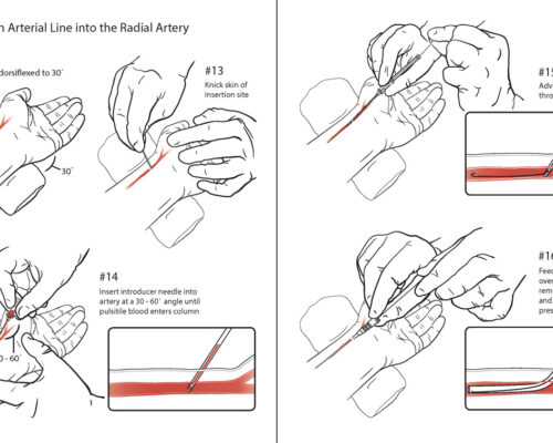Designer BioMed - Arterial Line Procedure Illustration Designer BioMed – Arterial Line Procedure Illustration