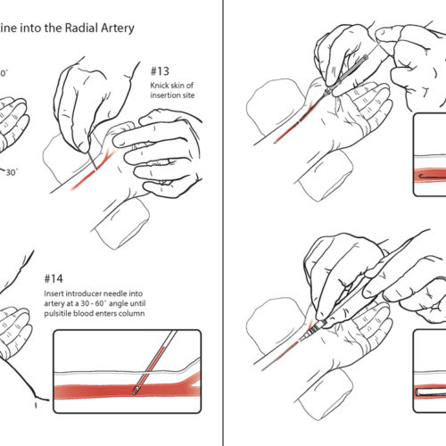 Designer BioMed - Arterial Line Procedure Illustration Designer BioMed – Arterial Line Procedure Illustration