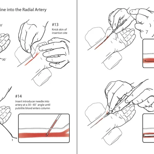 dmenken-designer-biomed-arterial-line-illustration-op (WebP) Dmenken designer biomed arterial line illustration op (WebP)