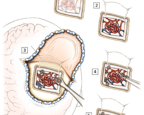 Designer BioMed - Cerebral AVM Resection Surgery Illustration Designer BioMed - Cerebral AVM Resection Surgical Illustration