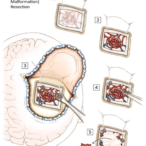 Designer BioMed - Cerebral AVM Resection Surgery Illustration Designer BioMed - Cerebral AVM Resection Surgical Illustration