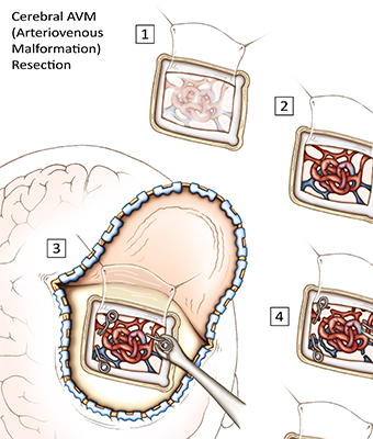 Cerebral AVM Resection Surgical Steps 2D Illustration