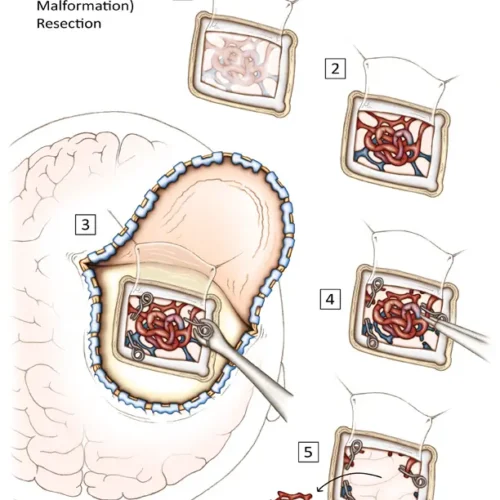 dmenken-designer-biomed-cerebral-avm-resection (WebP) Dmenken designer biomed cerebral avm resection (WebP)