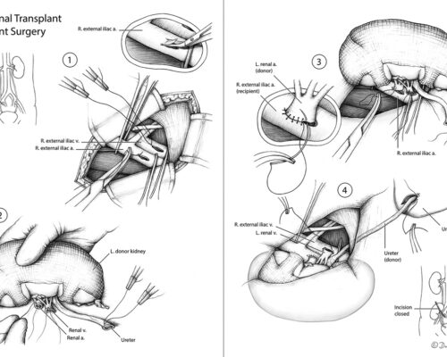 Designer BioMed - Renal Transplant Surgery Designer BioMed - Renal Transplant Surgery