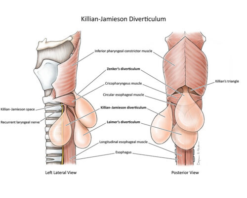 designer-biomed-diverticula-illustration