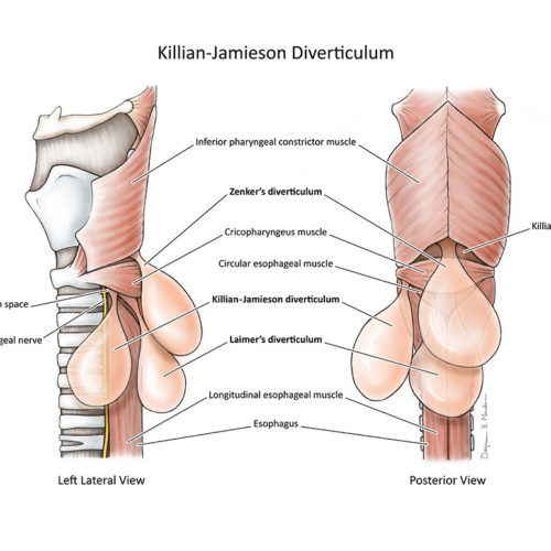 designer-biomed-diverticula-illustration designer-biomed-diverticula-illustration
